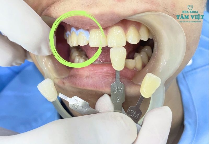 Cách ly nướu đảm bảo an toàn