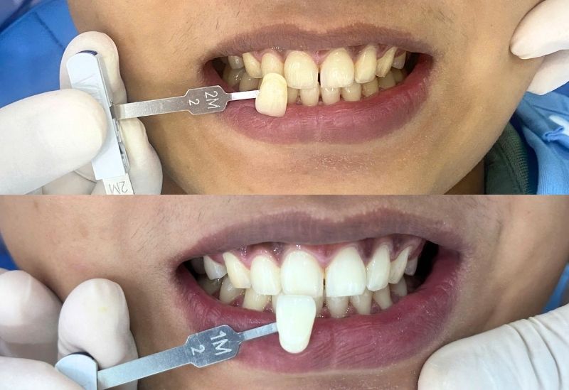 Hiệu quả bất ngờ khi tẩy trắng răng Laser
