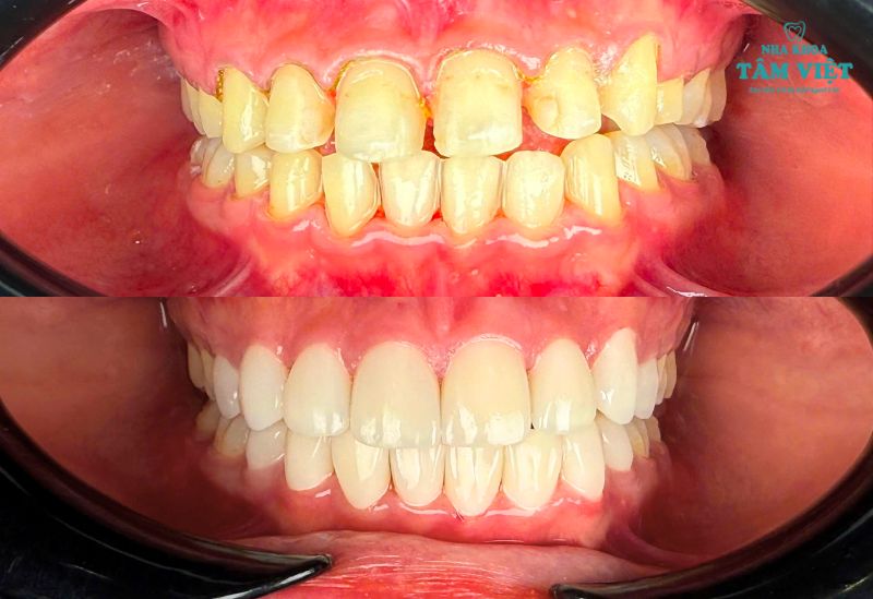 Kết quả dán sứ tại Tâm Việt