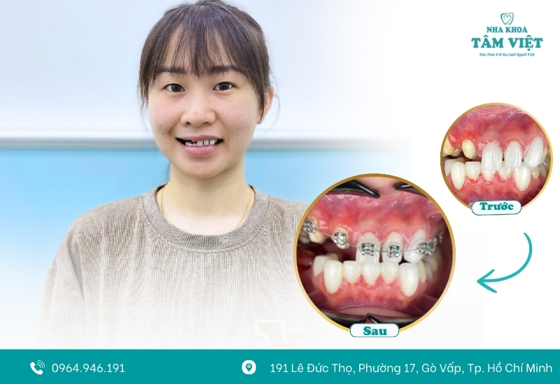 Quy trình niềng răng không đau tại Tâm Việt