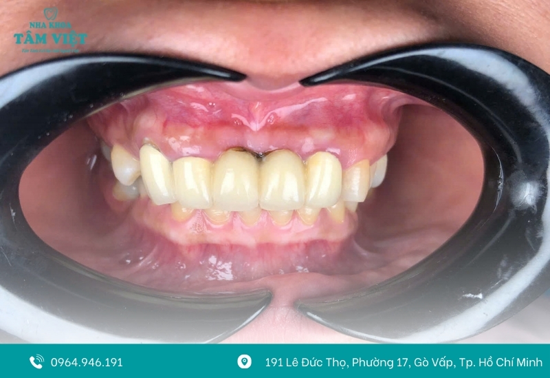 Viền nướu đen do sứ kém chất lượng