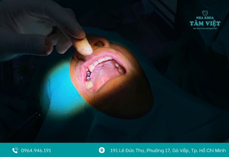 Cấy ghép implant tại Tâm Việt
