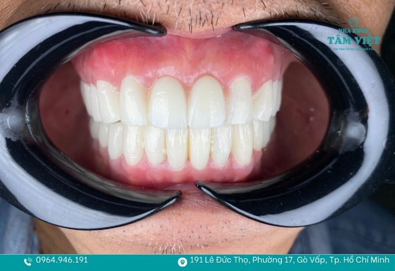 Thiết kế mão sứ chuẩn đảm bảo không đau nhức