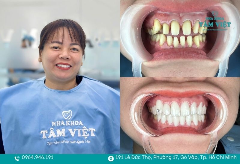 Bọc răng sứ an toàn tại Tâm Việt