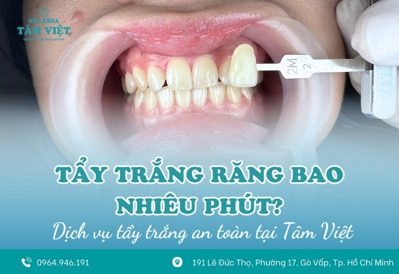 Tẩy trắng răng bao nhiêu phút? Có nhanh không?