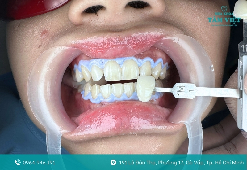 Mẹo giúp duy trì hiệu quả tẩy trắng lâu hơn