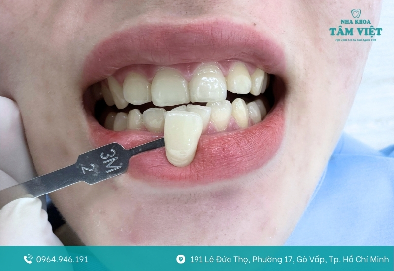Các yếu tố ảnh hưởng đến thời gian tẩy trắng răng