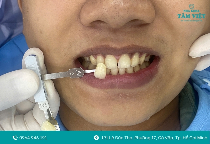 Tình trạng răng miệng quyết định mức giá và phương pháp