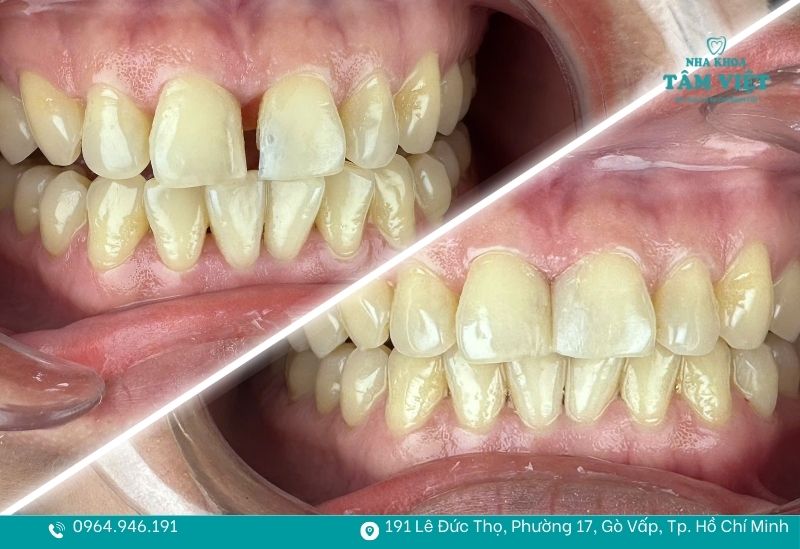 Nha khoa Tâm Việt trám răng cửa thưa