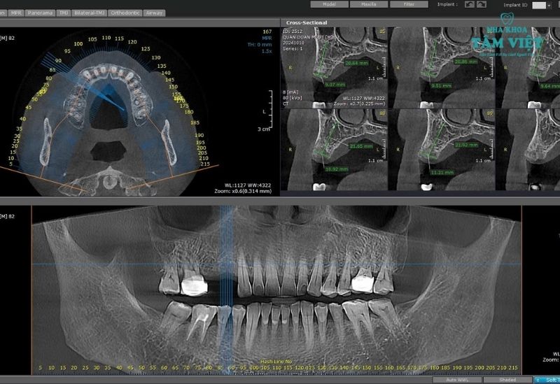 Hình ảnh mất răng cần trồng răng implant