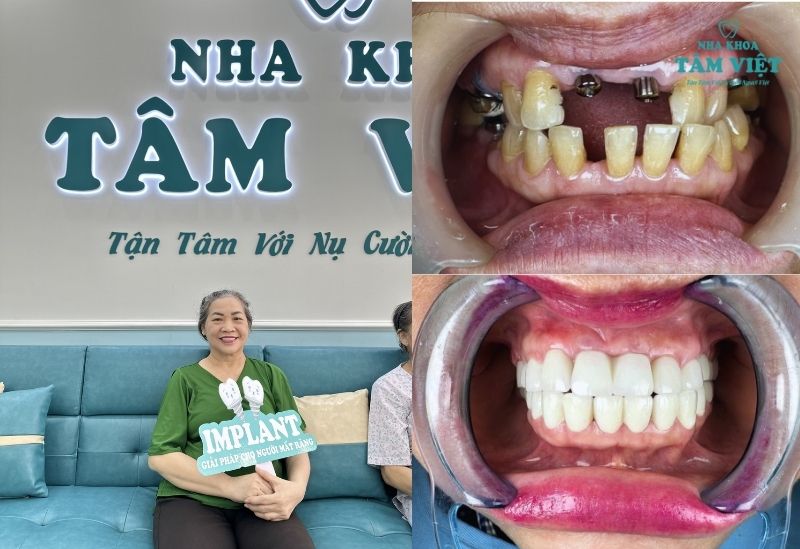 Khách hàng lớn tuổi trồng răng tại Tâm Việt
