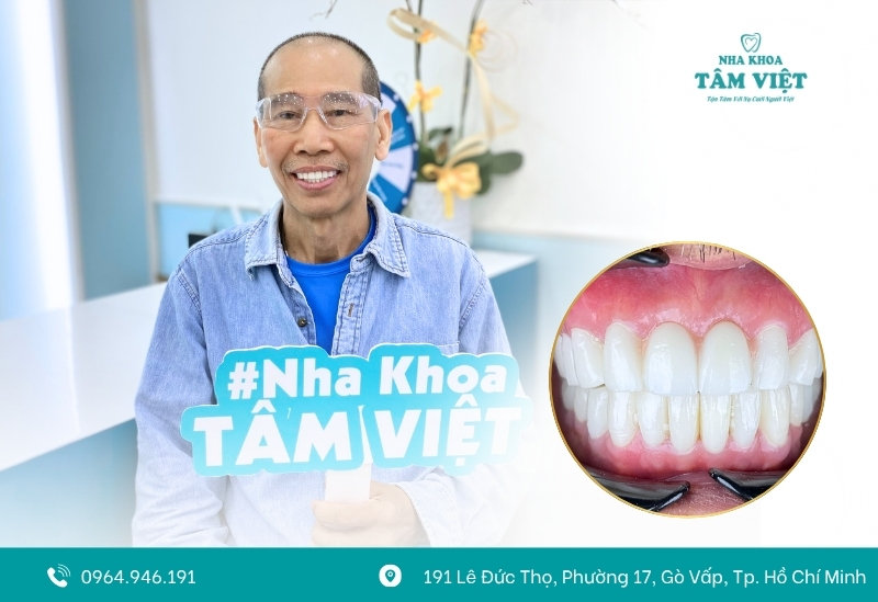 Các giai đoạn phục hồi sau khi bọc răng sứ