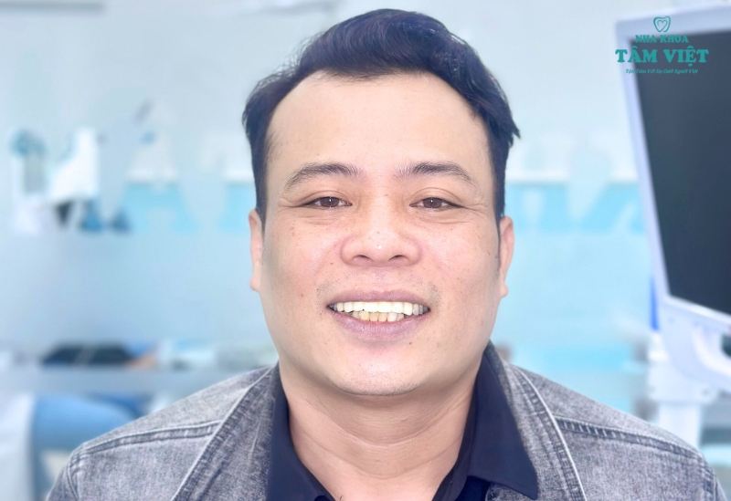 Bọc sứ cho răng mọc lệch mang lại ưu điểm vượt trội