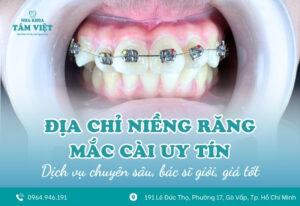 Địa chỉ niềng răng mắc cài uy tín, giá tốt 2025