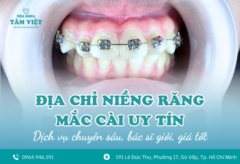 Địa chỉ niềng răng mắc cài uy tín, giá tốt 2025 1 Địa chỉ niềng răng mắc cài uy tín, giá tốt 2025
