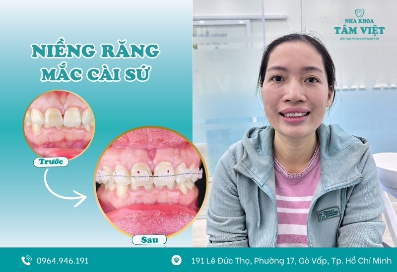 Niềng răng mắc cài sứ đảm bảo tính thẩm mỹ