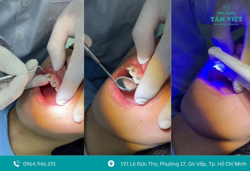 Gắn mắc cài và hướng dẫn chăm sóc răng miệng