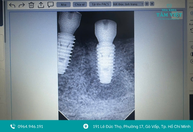 Vật liệu trồng răng chính hãng, an toàn