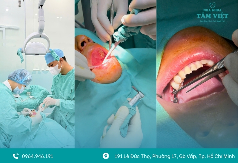 Quy trình trồng răng tại Nha khoa Tâm Việt