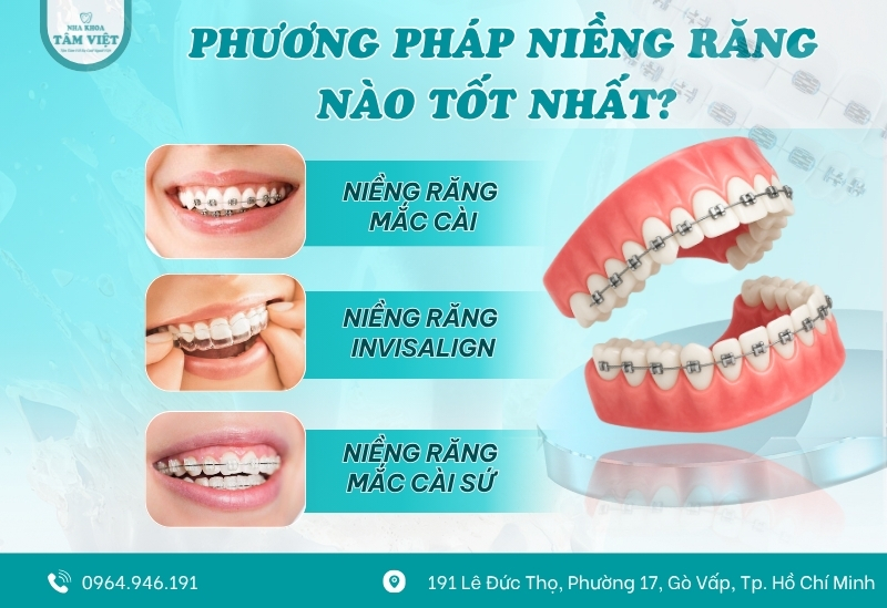 Tâm Việt cung cấp đa dạng phương pháp niềng răng