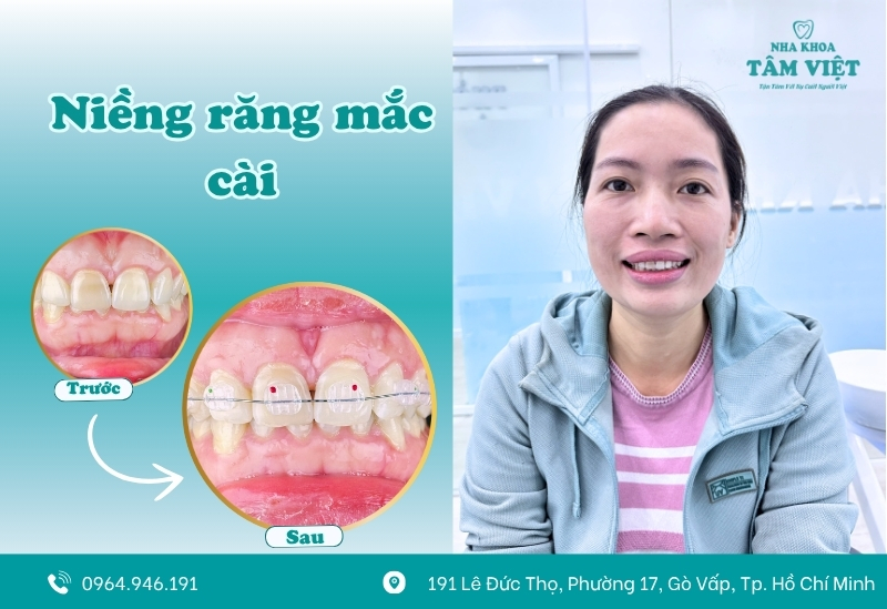 Quy trình niềng răng trả góp tại Nha khoa Tâm Việt