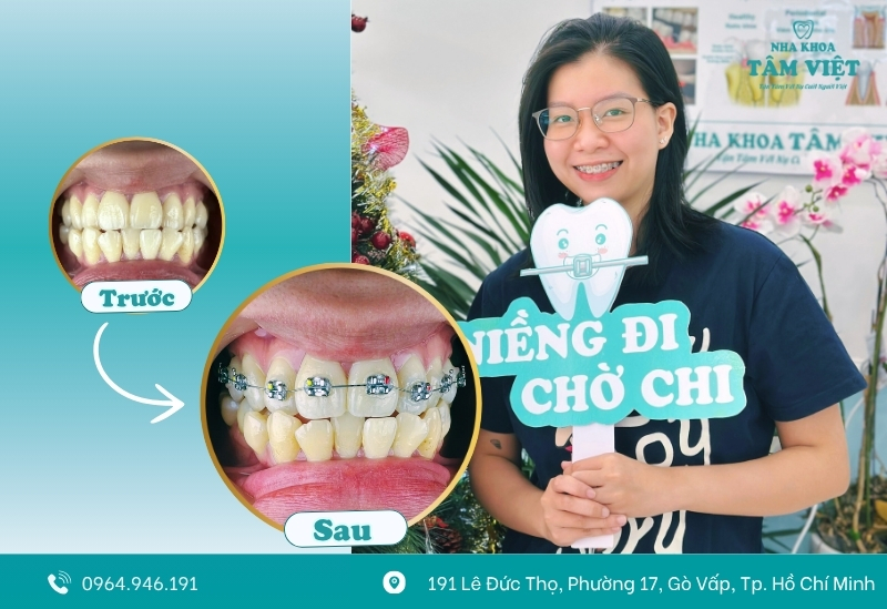 Niềng răng ở đâu có trả góp?