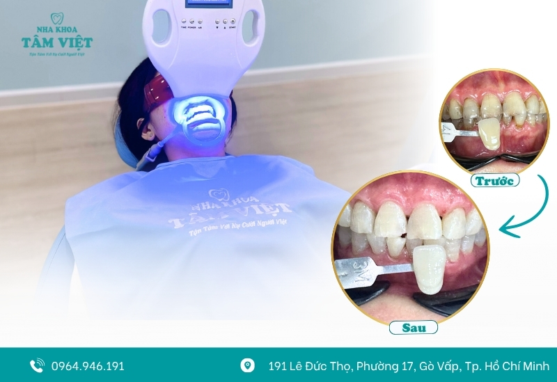 Quy trình tẩy trắng răng an toàn