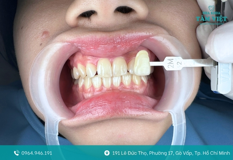 Cách phòng ngừa đau nướu hiệu quả