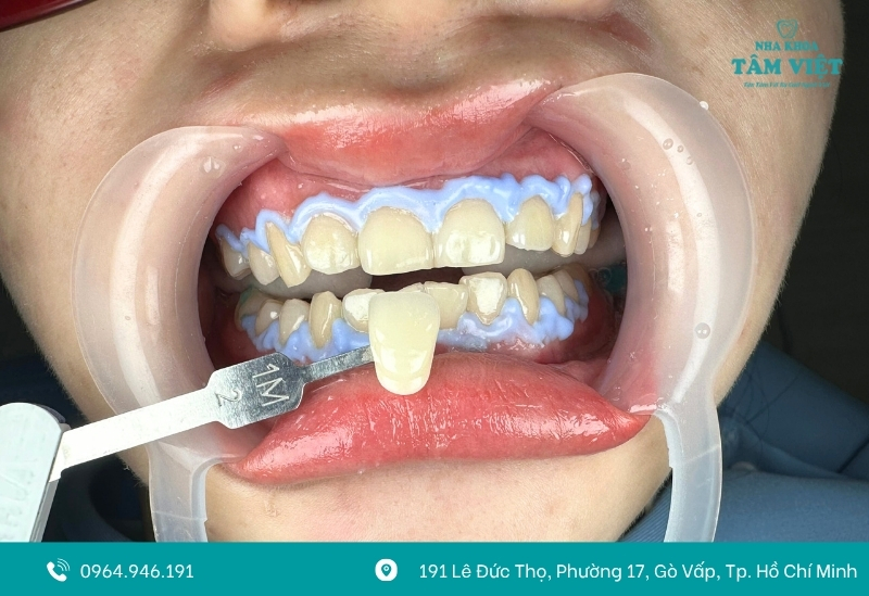 Nguyên nhân gây đau nướu khi tẩy trắng răng