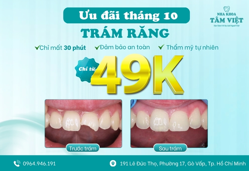 Ưu đãi trám răng chỉ từ 49K trong tháng 10