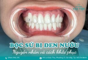 bọc răng sứ bị đen nướu