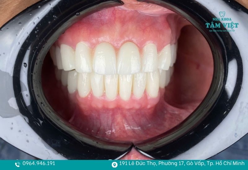 Kỹ thuật bọc răng sứ chuẩn