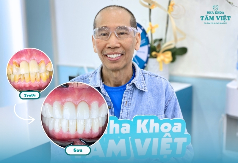 Khi nào nên bọc sứ cho răng mọc lệch?