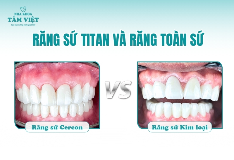 Loại răng sứ phổ biến hiện nay