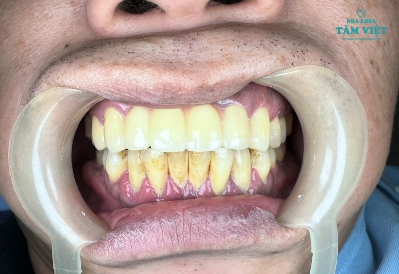 Răng mọc lệch là gì?