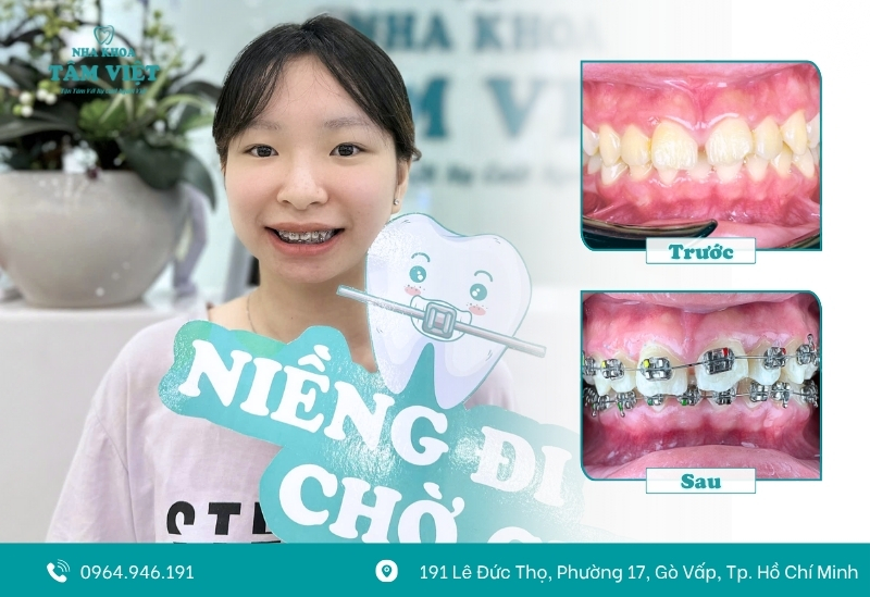 Nguyên nhân gây đau khi niềng răng