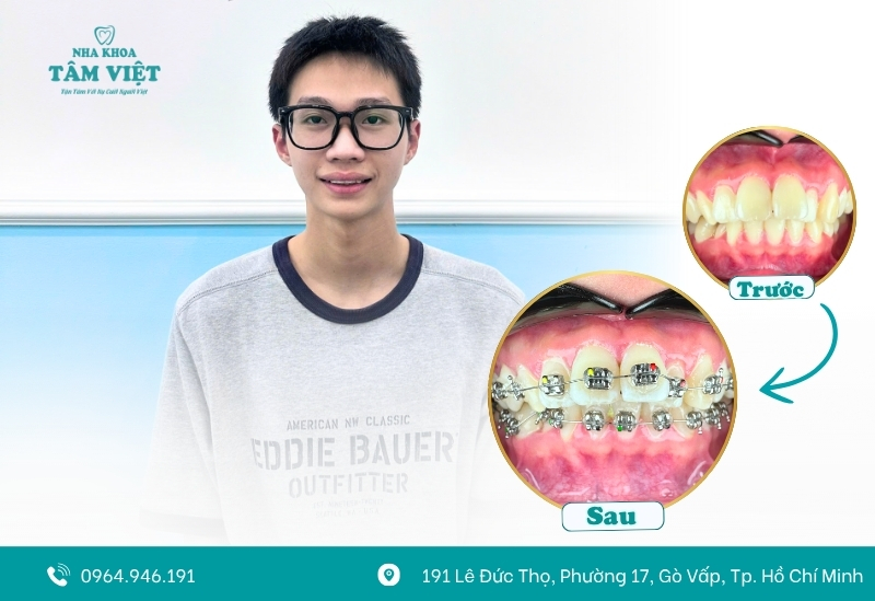 Cần có chế độ ăn uống phù hợp khi niềng răng