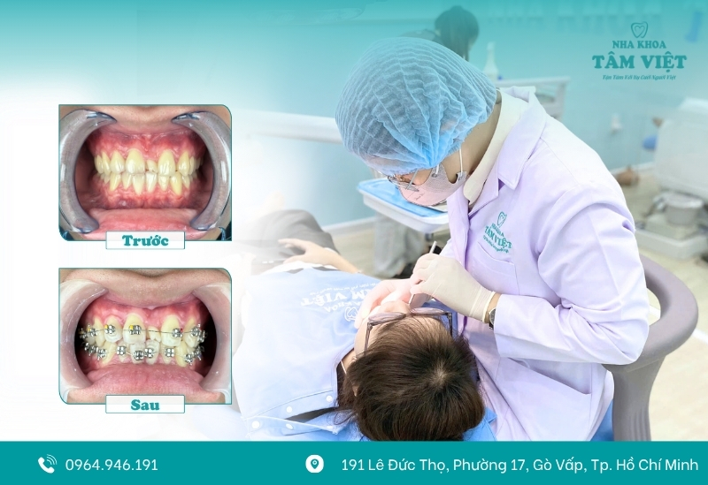 Tâm Việt ứng dụng các phương pháp niềng tiên tiến