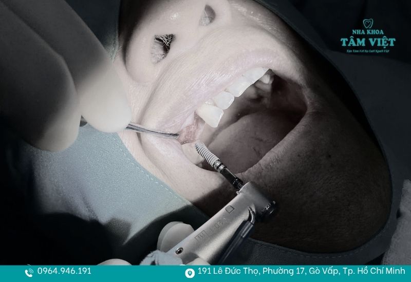 Tình trạng mất răng