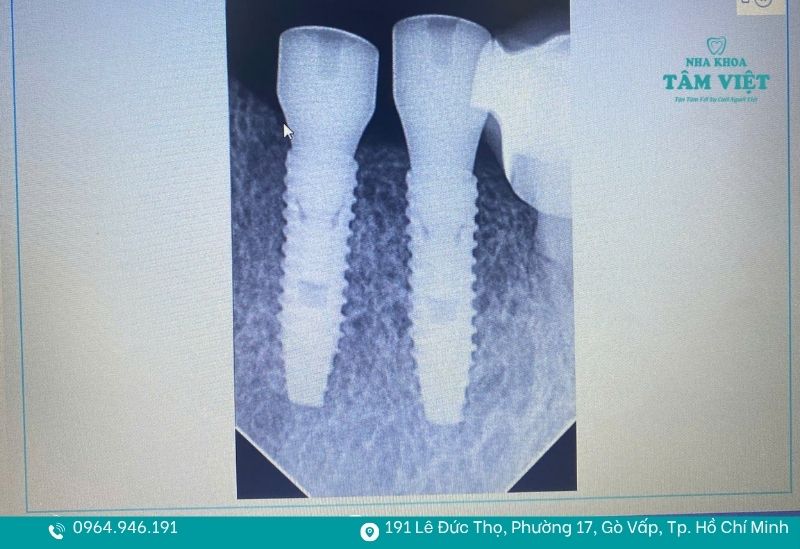 Trồng răng implant ngay sau khi nhổ răng
