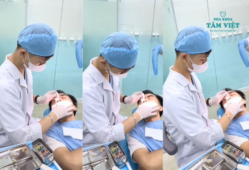 Trám răng thẩm mỹ chuẩn Y khoa tại Tâm Việt