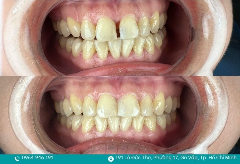 Hàn răng hiệu quả tại Nha khoa Tâm Việt