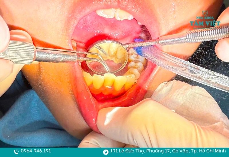 Loại bỏ vôi răng bằng công nghệ siêu âm