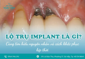 Lộ trụ implant là gì? Nguyên nhân và cách khắc phục