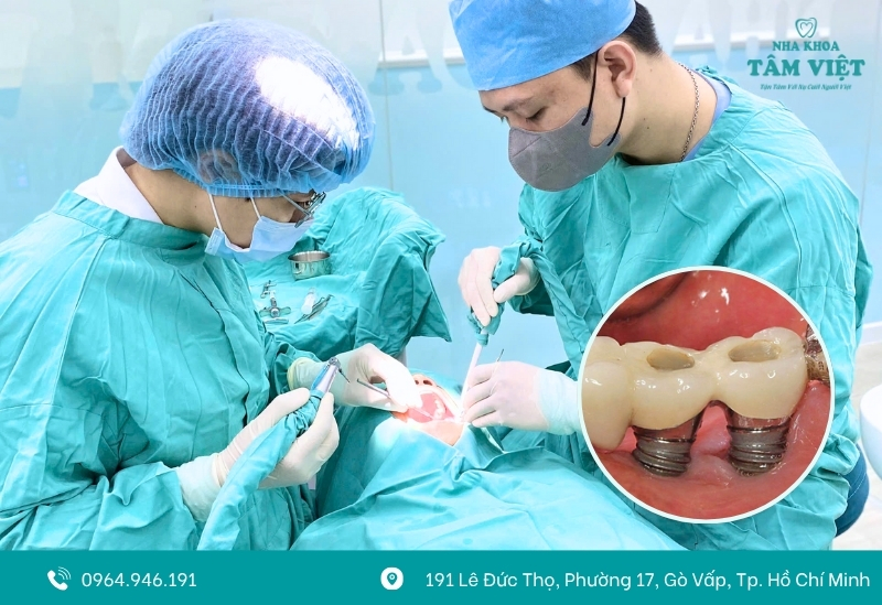 Lộ trụ implant là gì?