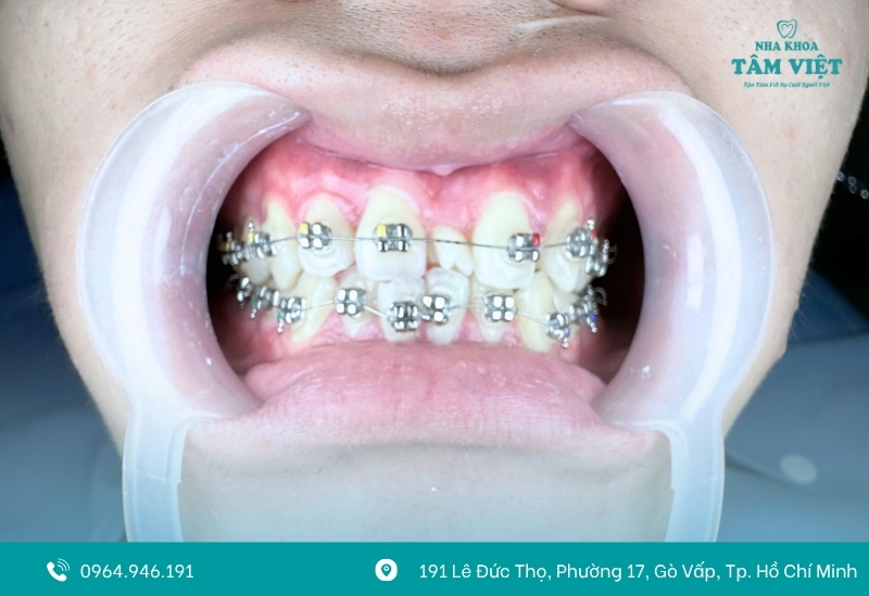 Nguyên nhân khiến niềng răng bị hôi miệng