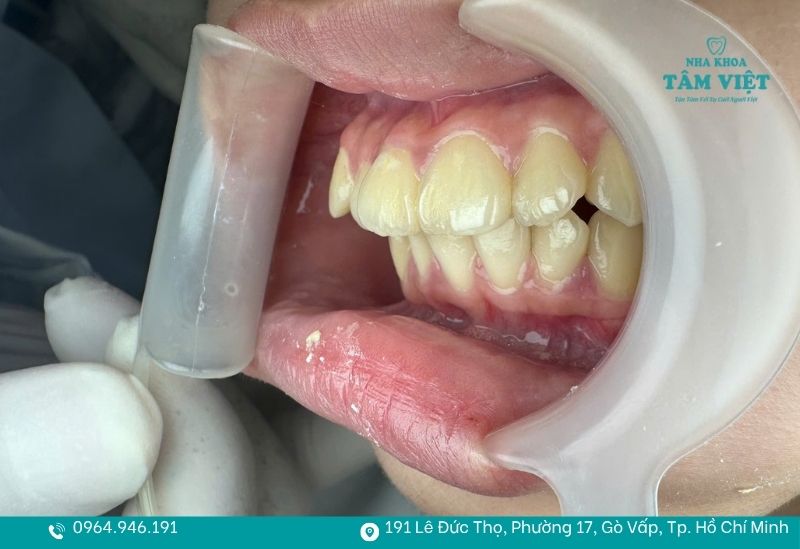 Dạng khớp cắn hô