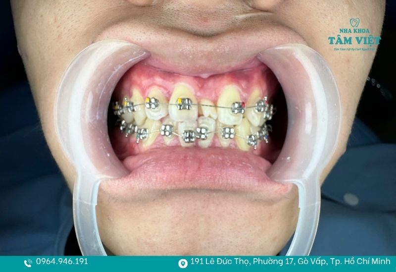 Tuân thủ thời gian đeo niềng