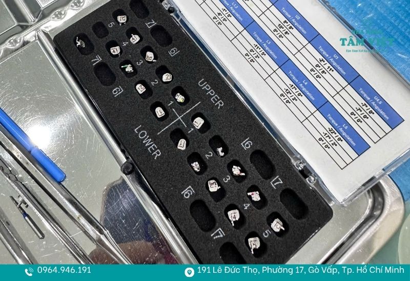 Mắc cài và dây cung chất lượng cao