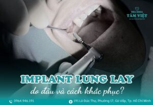 răng implant bị lung lay